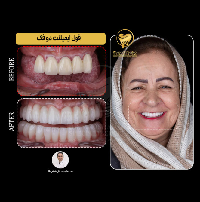 فول ایمپلنت دو فک